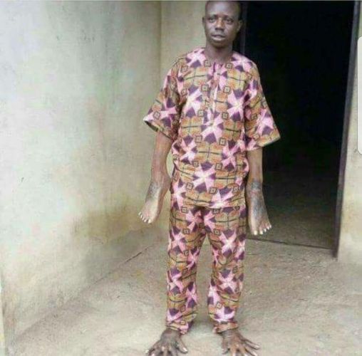 Man Had His Hands And Legs Switched After Sleeping With Someone's Wife