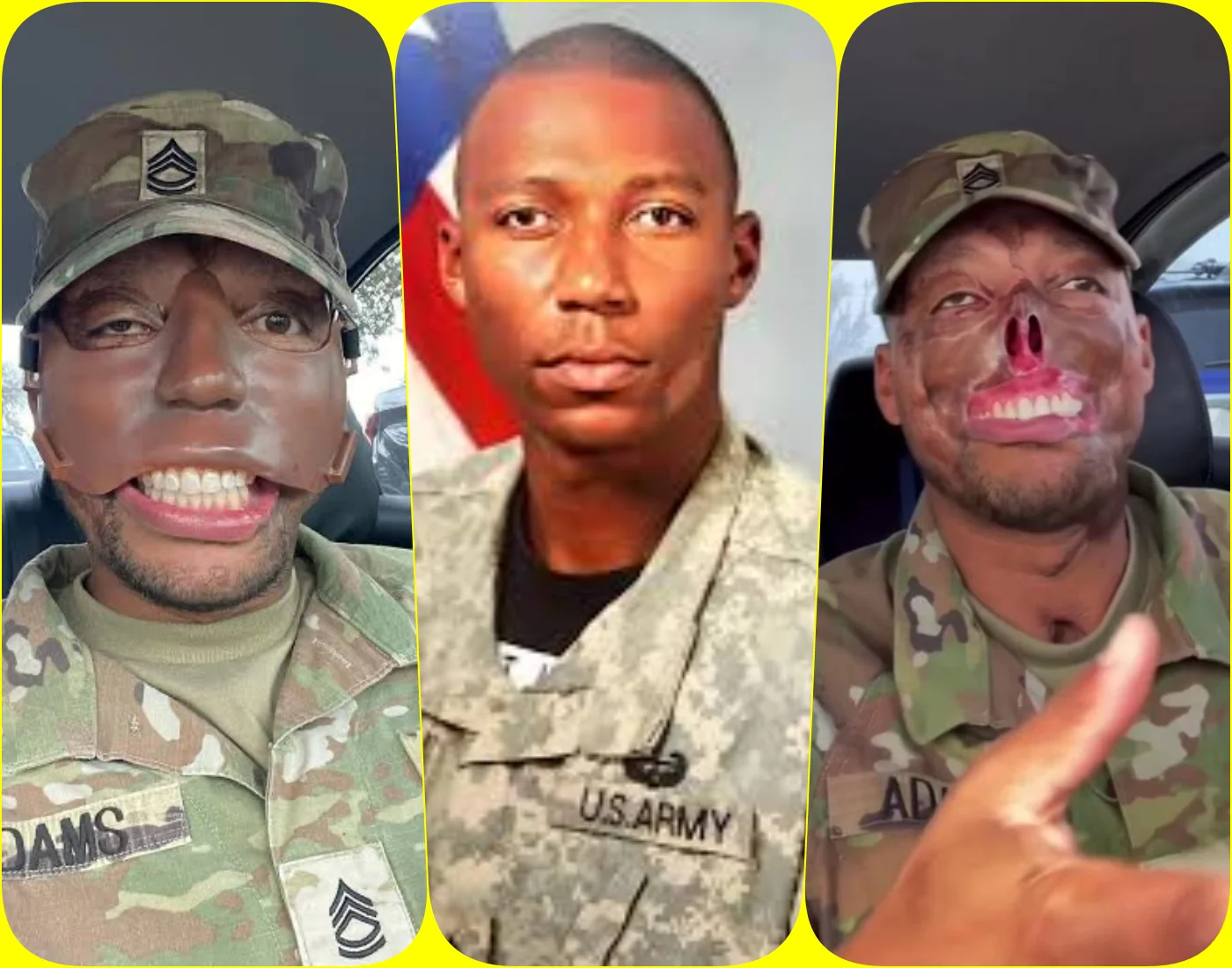 Randy Adams – The U.S. Army Veteran Who Lost Half His Face
