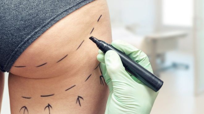Second Brit dies after'Brazilian butt lift' surgery